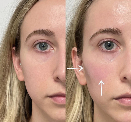 Skinject Deep Hyaluronic Acid Dermal 2ml ฟิลเลอร์ริมฝีปาก Injectable