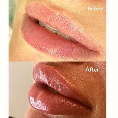 ฟิลเลอร์ฉีดฉีด Juvederms Ultra 3 HA Dermal Filler สำหรับ Lip Volume