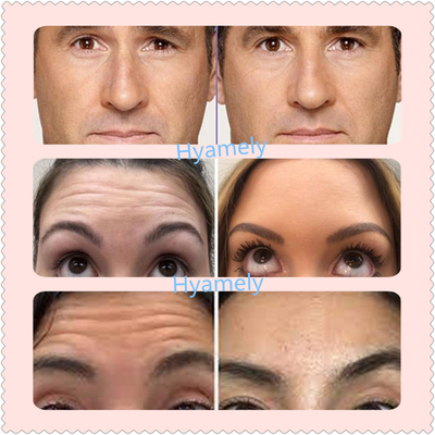 ตุรกี Allergan  100 IU Botulinum Toxin ติดทนนาน