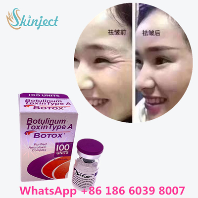 Botulinum Toxin  Wrinkle Removal 100u Allergan 100 Units สำหรับการฉีดยกกระชับใบหน้า