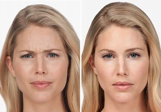 100 Iu Anti Wrinkle Products Korea Botulinum Toxin โบท็อกซ์ Type A