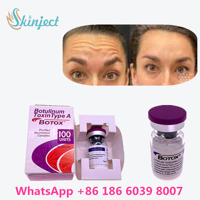 Botulinum Toxin ของแท้ 100%  100u สำหรับลบริ้วรอย