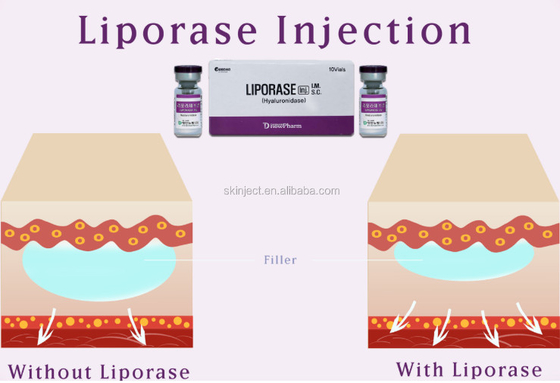 10 Vias Liporase Hyaluronidase สำหรับฟิลเลอร์ผิวหนังเพื่อละลาย