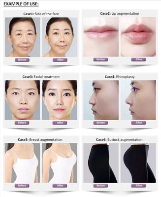 1.1ml Revolax Deep Hyaluronic Dermal Filler สำหรับผิวหน้า