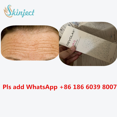 Hyaluronic Acid Dermal Revolax Deep Filler 1ml สำหรับฉีดริมฝีปาก