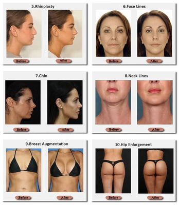 Skinjection 10 Ml และ 20 Ml Hyaluronic Breast Filler เทคโนโลยีเกาหลี 24 Mg / Ml