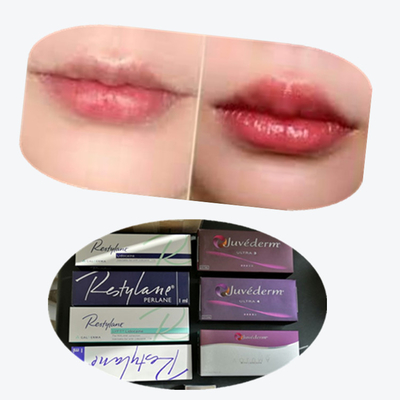 2*1ml/Box Cross Linked Dermal Filler สําหรับการขยายริมฝีปาก