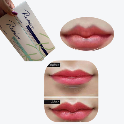 2*1ml/Box Cross Linked Dermal Filler สําหรับการขยายริมฝีปาก