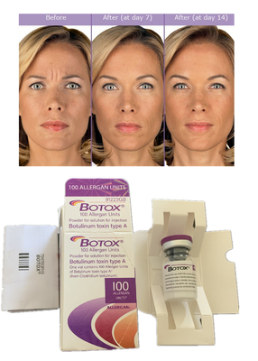 ยาฉีด อัลเลอร์แกน โบทูลินัม ท็อกซิน 100IU Anti Wrinkles Dermal Filler