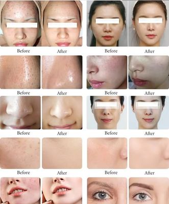 เครื่องนวดหน้า Hydra Dermabrasion มัลติฟังก์ชั่น 11 ใน 1