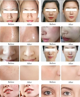 11 ใน 1 เครื่องทําความสะอาดผิวหน้า Hydra มีหลายฟังก์ชัน เครื่องทําความสะอาดผิวหน้า Black Pearl เครื่องทําความสะอาดผิวหน้า