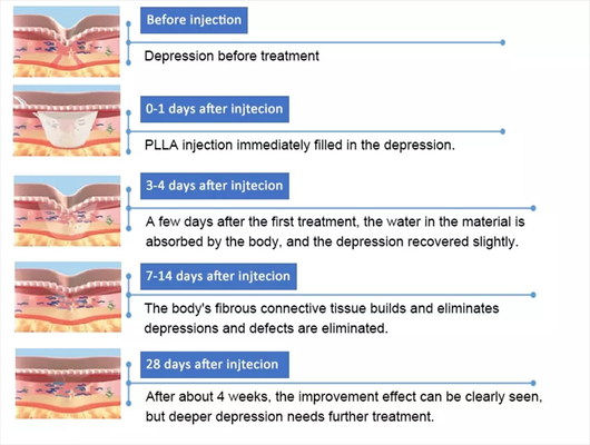 PLLA โพลี-เอล-เลคติก แอซิด การฉีดหน้า 10 ถัง 150 มิลลิกรัม