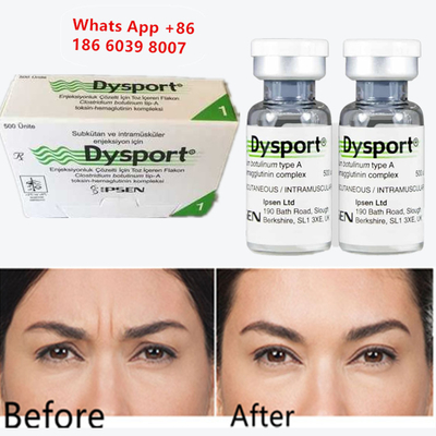 โบทูลินัม ท็อคซีน A Dysport โบโต็กซ์ฉีดสําหรับการขยายคาง