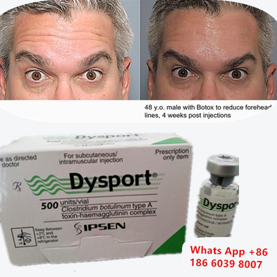 โบทูลินัม ท็อกซิน A Dysport Botox การฉีดสําหรับเส้นริมฝีปาก