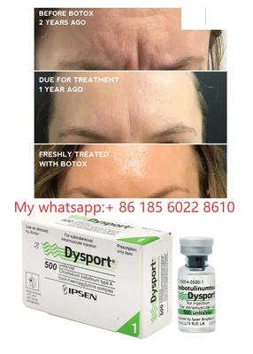 การฉีด Dysport 500IU โบทูลินัม ท็อกซิน Allergan Botulax - ลดเลือนริ้วรอยและรอยย่น