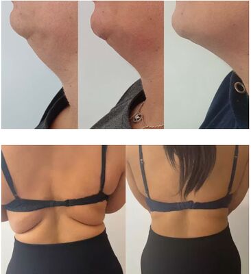 น้ำยาฉีดสลายไขมัน Lemon Bottle