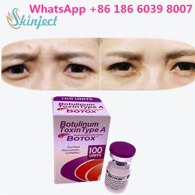สารโบทูลินัมท็อกซิน ALLERGAN BOTOX ระยะเวลา 4 ถึง 6 เดือน 100 ยูนิต ชนิด เอ