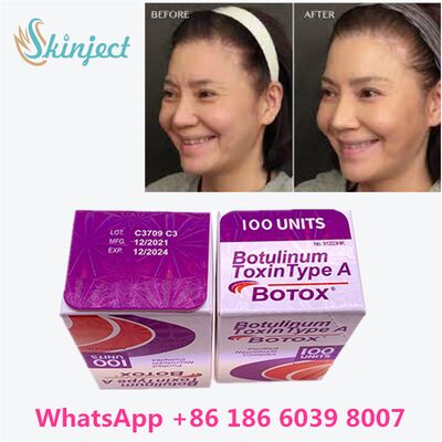 อัลเลอร์แกน โบท็อกซ์ โบทูลินัม ท็อกซิน ชนิดเอ 100 ยูนิต สำหรับลบริ้วรอย คงอยู่ 4-6 เดือน