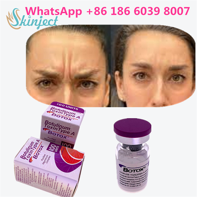 โบทูลินัม ท็อกซิน BOTOX คอสเมติก 100 ยูนิต Allergan OnabotulinumtoxinA สำหรับริ้วรอยบนใบหน้า