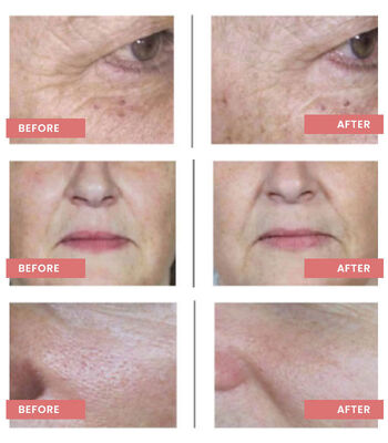 FILLMED NCTF 135HA Anti-Aging Skin Booster Rejuvenation Mesotherapy Solution