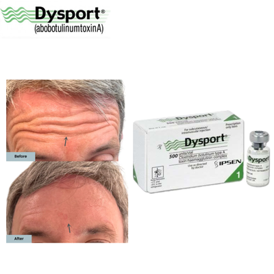 Clostridium Botulinum Type A Toxin Dysport 500 Unit Lyophilized Powder Injection for Fine Lines