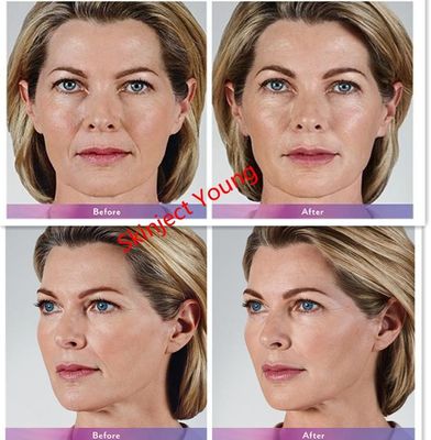 Juvederm Voluma 2x1ml ฟิลเลอร์เจลฉีดกรดไฮยาลูโรนิก