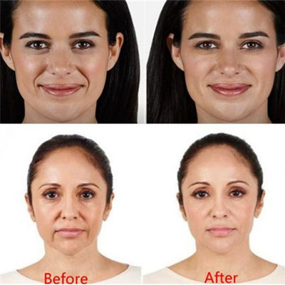 Juvaderm Voluma ฟิลเลอร์ปากกากรดไฮยาลูโรนิกสำหรับริ้วรอยรอบดวงตา
