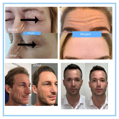 Hyamely Botax Wrinkle Removal Injection 100 ยูนิต Botulinum Toxin Beauty