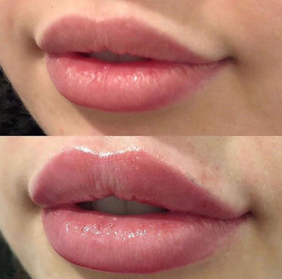 Russian Lips Juvederm Ultra 3 พร้อม  Cross Linked Dermal Filler