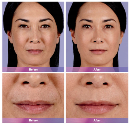 Juvederm Dermal Filler Lip Injection Ultra 4 สำหรับการขยายขนาดริมฝีปาก
