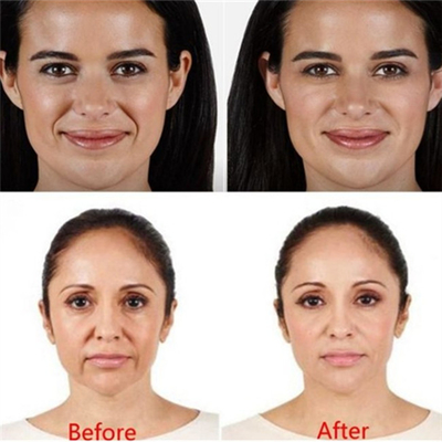 ฟิลเลอร์ใบหน้ากรดไฮยาลูโรนิก Juvederm Voluma Hyaluronidase Injection