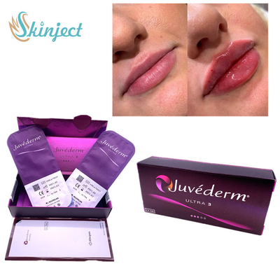 Nasolabial Folds Lips 2x1ml Dermal Filler กรดไฮยาลูโรนิก Juvederm Ultra3