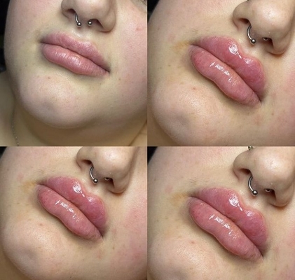 Revolax Deep HA Dermal Filler ลิปฉีด Ce Marked
