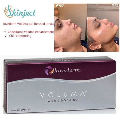 Juvederm Voluma 2x1ml Hyaluronic Acid Dermal Fillers สำหรับโหนกแก้ม