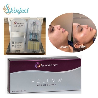 Juvederm Voluma Dermal Filler กรดไฮยาลูโรนิกสำหรับใบหน้าแก้มคาง Contour
