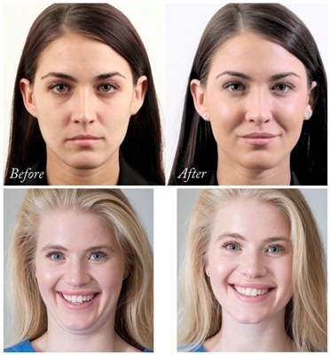 อัพเกรด Juvederm Voluma Hyaluronic Acid Facial Filler 24 Mg / Ml