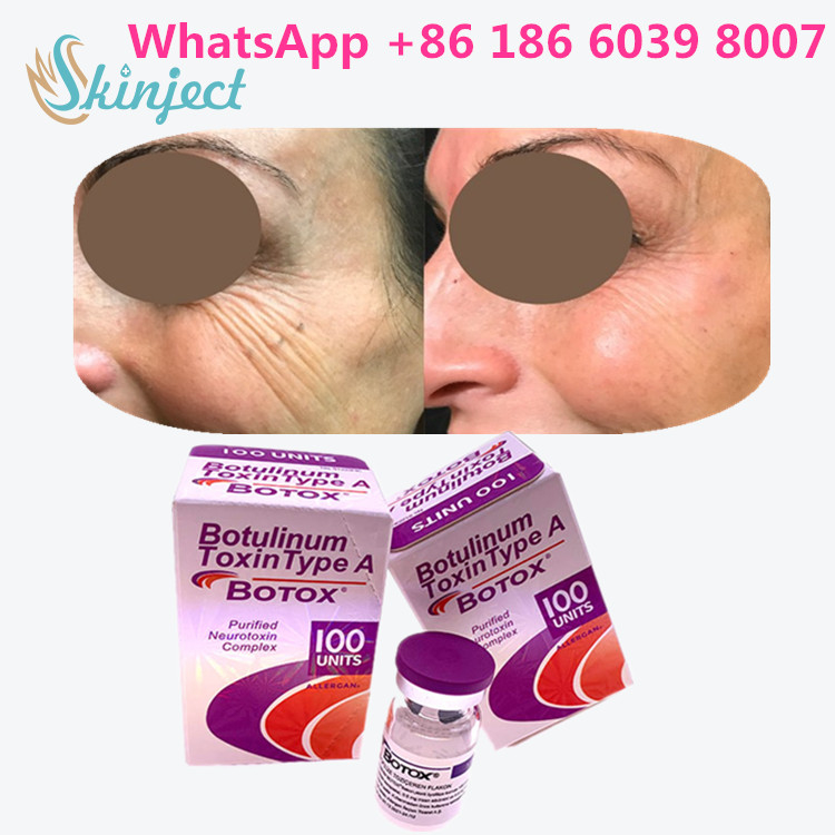 Botulinum Toxin Allergan  Type A 100units 1 ขวด/กล่องบรรจุ