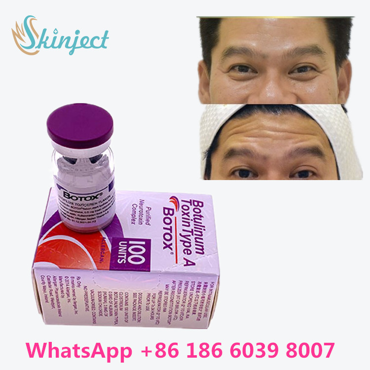 100 Units Type A Botulinum Toxin 2 - 8°C อุณหภูมิในการจัดเก็บ