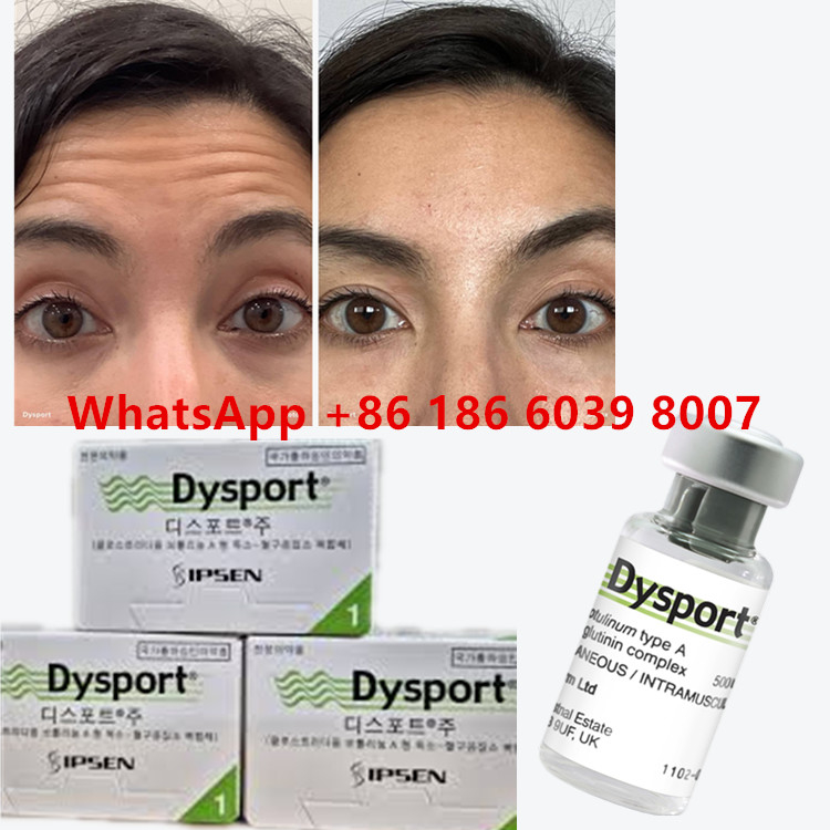 โบทูลินัม ท็อกซิน ดิสปอร์ต คลอสทริดีอุม โบทูลินัม ประเภท A 500 ยูนิต/ขวด สําหรับเส้นผิว
