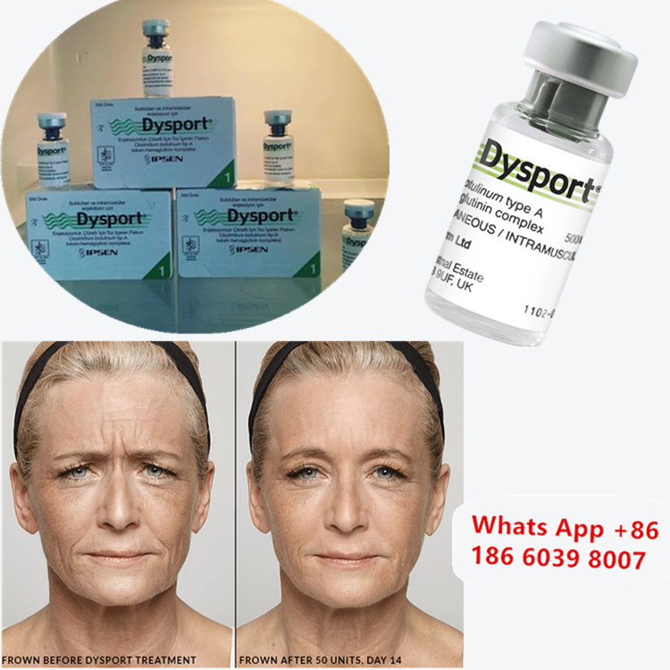Dysport 500u Botulinum Toxin ประเภท A สําหรับการขยายแก้ม