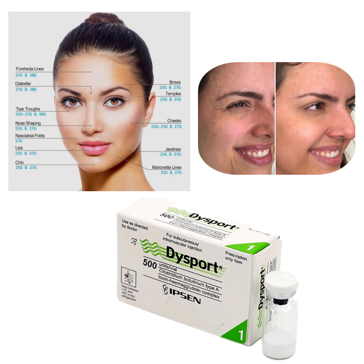 Dysport 500U โบทูลินัม ท็อกซิน ชนิด A สำหรับการรักษาเพื่อลดริ้วรอย