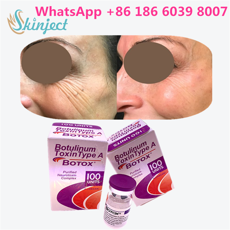 Botulinum Toxin Allergan BTX Cosmetic 100 Units – Professional Use for Smooth Forehead & Frown Lines