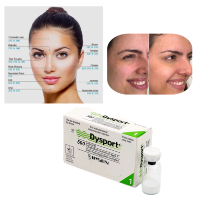 Dysport 500U โบทูลินัม ท็อกซิน ชนิด A สำหรับการรักษาเพื่อลดริ้วรอย