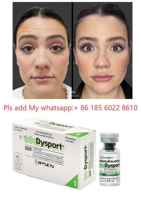 การฉีด Dysport 500iu ลดเลือนริ้วรอย โบทูลินัม ท็อกซิน Allergan Botulax